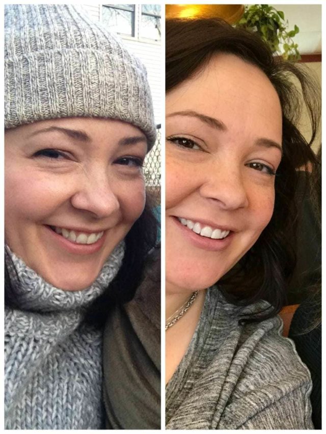 before after teeth whitening over 40