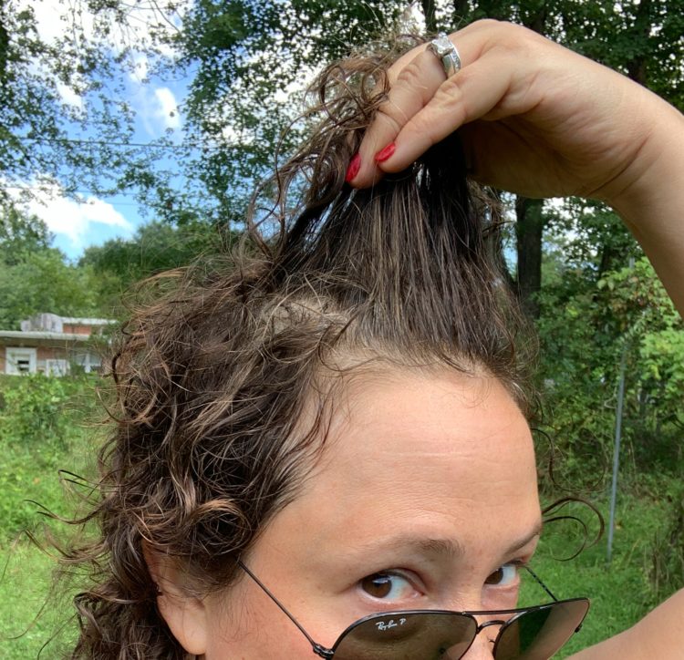 Woman holding up her hair to show thinningand scalp